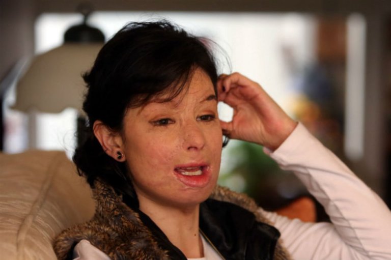 Natalia Ponce será condecorada en Bogotá por su lucha contra los ataques con ácido