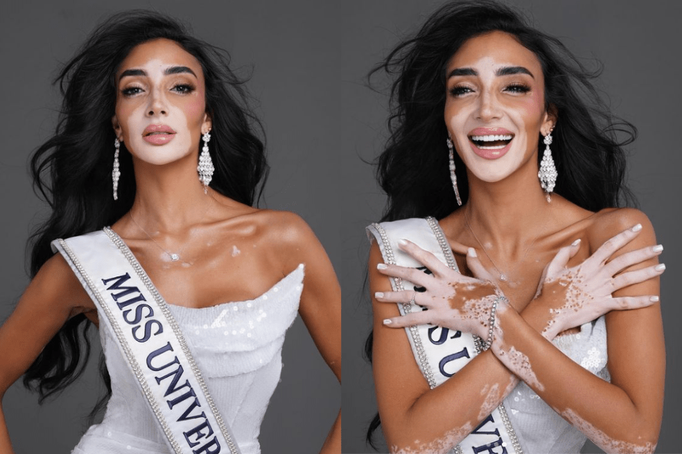 ¿Ya conoces a Logina Salah? La primera modelo con vitíligo que participa en Miss Universe 2024, como representante de Egipto. Te contamos la historia inspiradora de la modelo que marca un hito en este certamen de belleza.