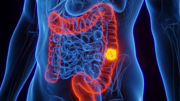 El cáncer colorrectal afecta cada vez más a jóvenes menores de 50 años