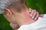 ¿Cómo evitar que te piquen los mosquitos durante el verano? Es muy fácil