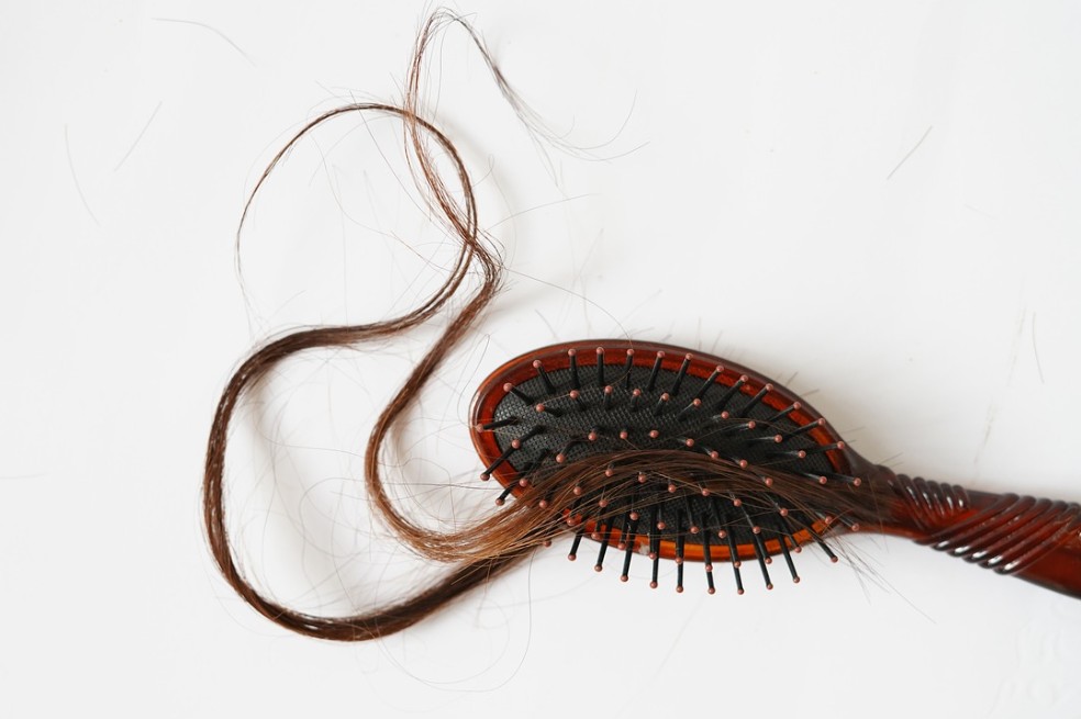 La alopecia areata es una enfermedad autoinmunitaria que genera caída del cabello. (Imagen de referencia).