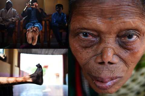 El estigma de la lepra en India, una enfermedad que no muere y tiende a resurgir
