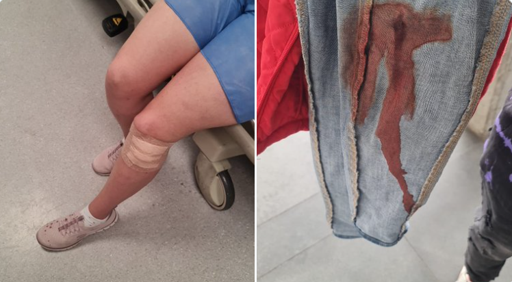 Esposa del Concejal Ospina fue lesionada en hurto violento.