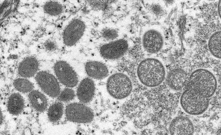 Papás, la viruela del mono es muy poco probable en niños. Piensen primero en varicela
