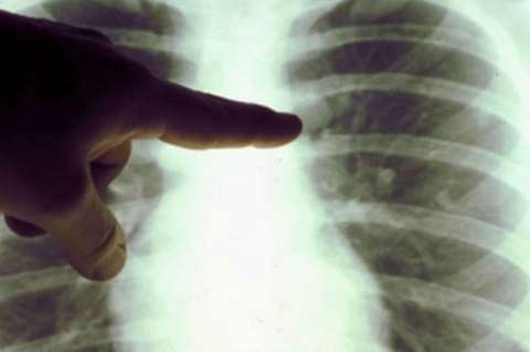 Cáncer de pulmón en EE.UU. causa más muertes en mujeres que el cáncer de mama