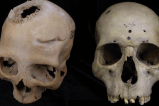 Hace 4.000 años, médicos del antiguo Egipto habrían intentando operar un cáncer