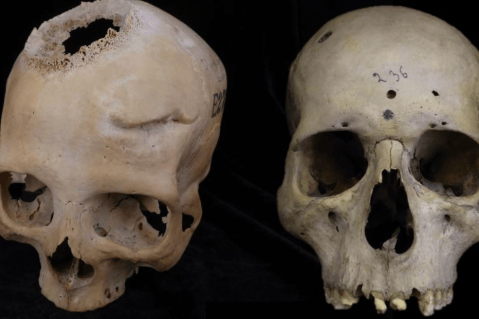 Hace 4.000 años, médicos del antiguo Egipto habrían intentando operar un cáncer
