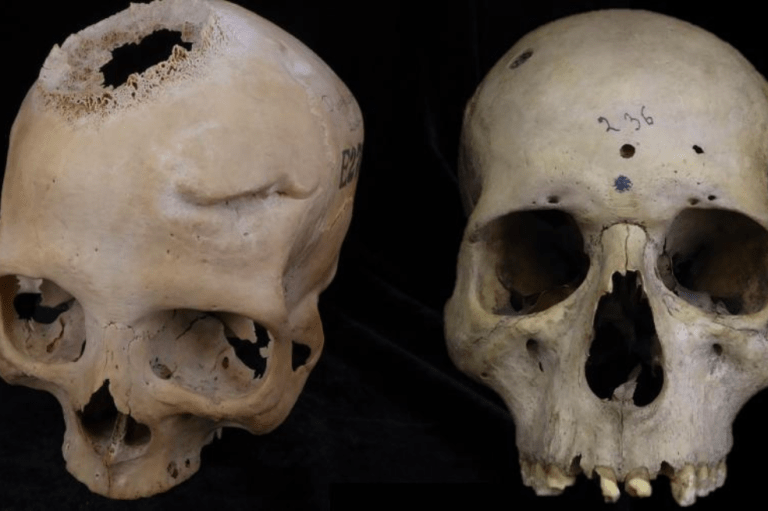 Hace 4.000 años, médicos del antiguo Egipto habrían intentando operar un cáncer