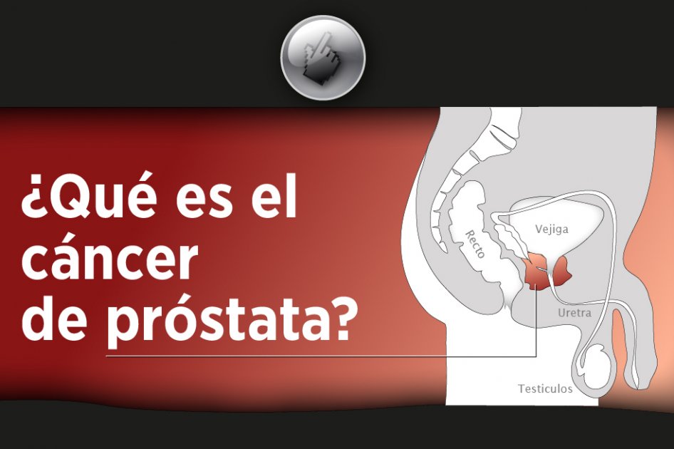 ¿Qué es el cáncer de próstata?