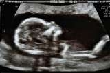 Bienvendios a la plasticenta: científicos presentan evidencia de microplásticos en placentas humanas