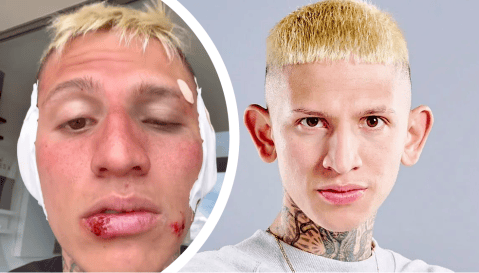 La Liendra explicó la razón de sus heridas en el rostro: “Casi pierdo mis orejitas”
