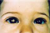 Un fármaco biológico para tratar el cáncer de retina en niños
