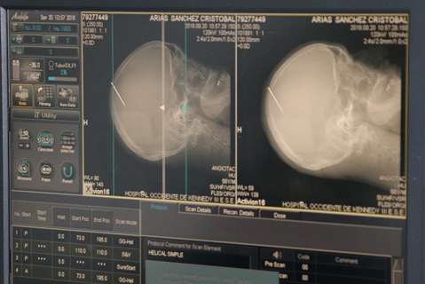 Hombre se salva de morir de una puñalada en la cabeza