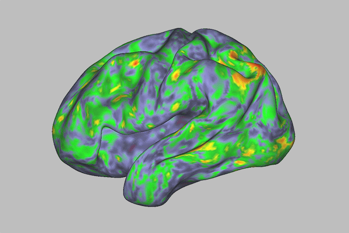 Este mapa de calor de los patrones de actividad cerebral muestra la profunda alteración durante la experiencia de un individuo después de tomar psilocibina. Los patrones relativamente estables antes y después de la dosis (tonos azules y verdes) se alteran temporalmente durante el "viaje" (tonos rojos, naranjas y amarillos). Investigadores de la Facultad de Medicina de la Universidad de Washington en St. Louis informan que la psilocibina desestabiliza una red crítica de áreas cerebrales involucradas en el pensamiento introspectivo. Los hallazgos proporcionan una explicación neurobiológica para los efectos alucinógenos de la droga.