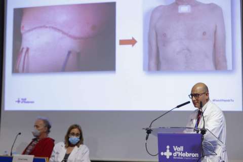 Realizan el primer trasplante de pulmón completamente robótico sin abrir el tórax