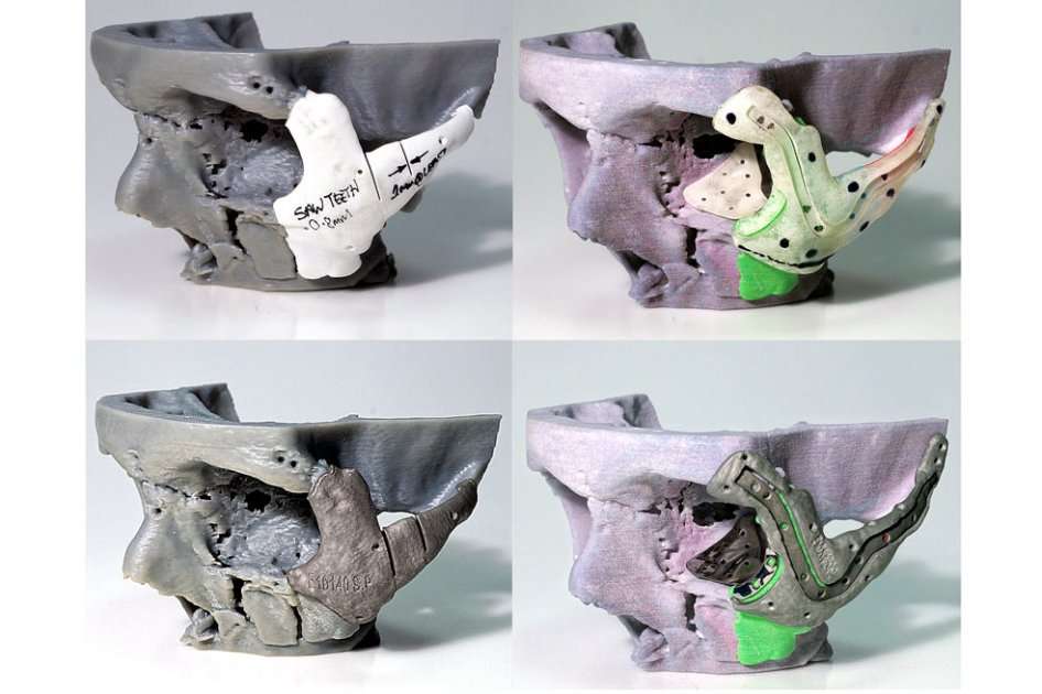 Modelos 3D de la cara de Stephen Power utilizados en el desarrollo y la planificación de su cirugía de reconstrucción facial