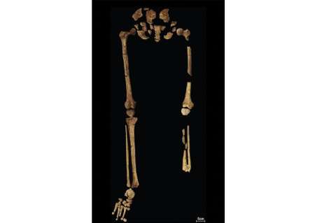La primera amputación quirúrgica exitosa fue hace 31.000 años