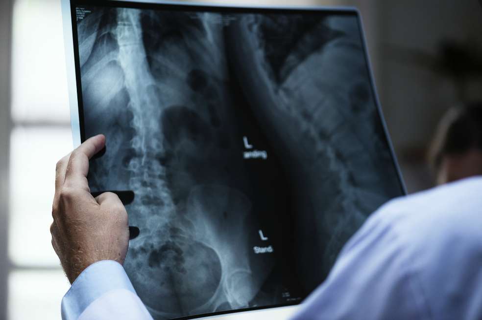 La multinacional fue multada por vender implantes para cadera con información engañosa. / Pixabay