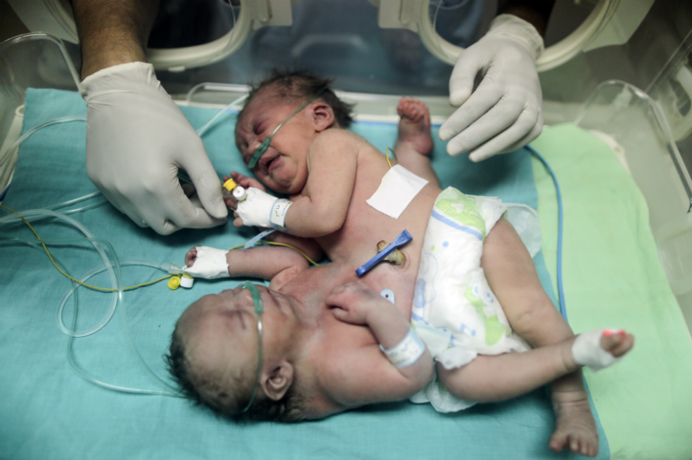 Las niñas estaban unidas por el vientre y la pelvis. / AFP