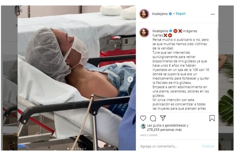 Lina Tejeiro se sometió a cirugía para retirar biopolímeros.