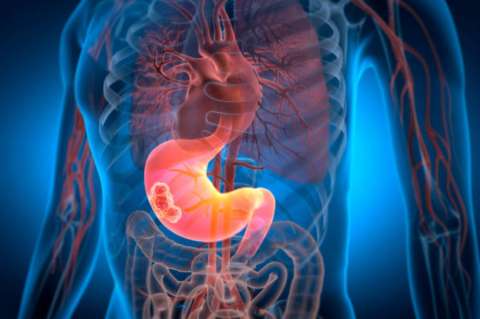 Cáncer de páncreas: nuevo medicamento duplica la supervivencia, pero debe verse con cautela