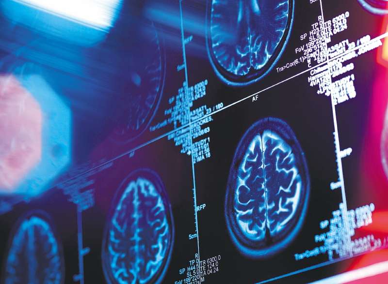 La células se convirtieron en precursoras de dopamina, un neurotransmisor escaso en pacientes con párkinson. Fue el primer paciente de siete en recibir este tratamiento. / Getty Images