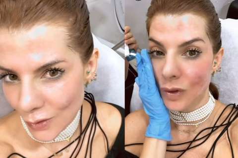 ¿Qué le pasó a Carolina Cruz en la cara?: “qué doloroso”