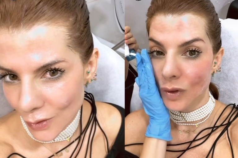 ¿Qué le pasó a Carolina Cruz en la cara?: “qué doloroso”
