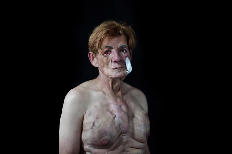 GALERÍA: El padecimiento de mujeres trans que se inyectaron biopolímeros