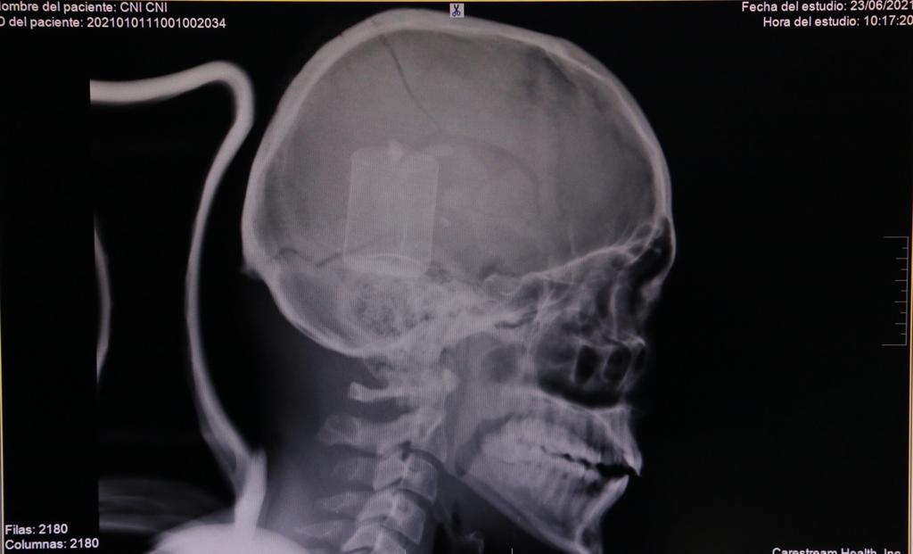 Radiografía del trauma craneoencefálico sufrido por Cristian Castillo.