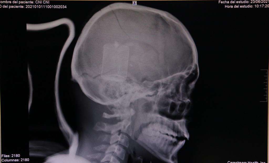 Radiografía del trauma craneoencefálico sufrido por Cristian Castillo.