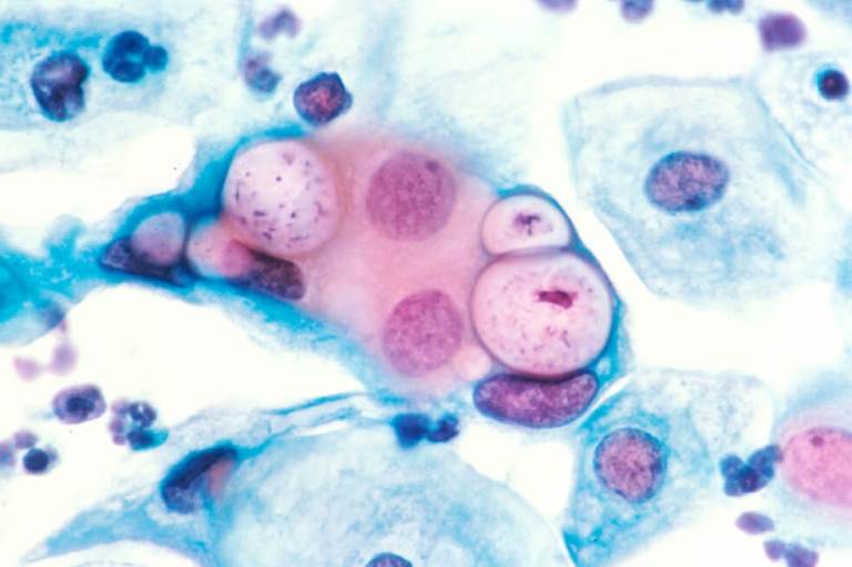 Más cerca de la vacuna contra la clamidia, la infección de transmisión sexual más frecuente