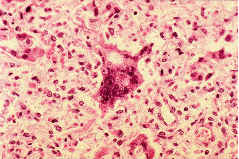 Células infectadas por el virus del sarampión. / Wikimedia Commons – CDC/ Dr. Edwin P. Ewing, Jr. - Centers for Disease Control and Prevention's Public Health Image Library (PHIL)