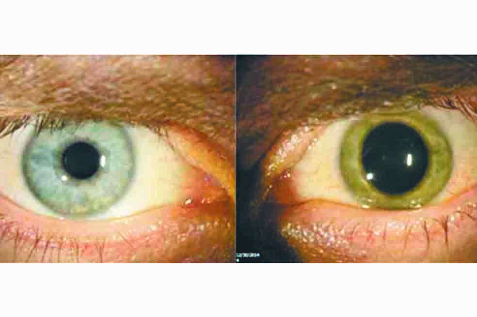 Antes de contraer el ébola, los ojos de Crozier eran azules. Después de haberse recuperado de la enfermedad, su ojo izquierdo se volvió verde. /Emory Eye Center