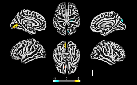 Investigadores brasileros usaron diferentes técnicas, entre ellas neuroimágenes, para evaluar los efectos del SARS-CoV-2 en el cerebro.