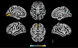 Comprueban que el SARS-CoV-2 afecta al cerebro y detallan efectos en neuronas