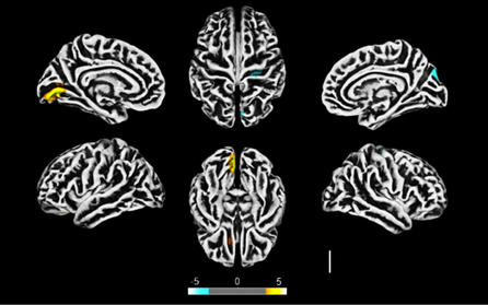 Comprueban que el SARS-CoV-2 afecta al cerebro y detallan efectos en neuronas