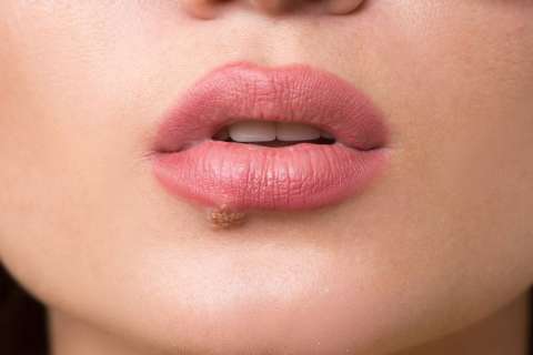 ¿Por qué salen los fuegos en los labios y cómo se quitan?