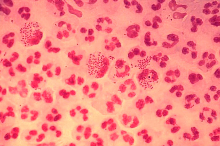 Supergonorrea podría propagarse por uso excesivo de antibióticos para COVID-19