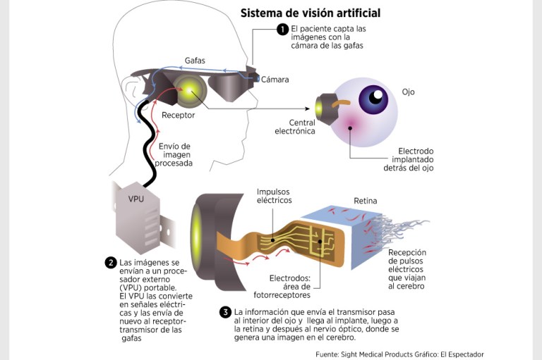 Listo ojo biónico, pero solo para ricos