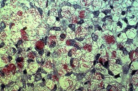 Preocupación porque la bacteria de la lepra se vuelve cada vez más resistente