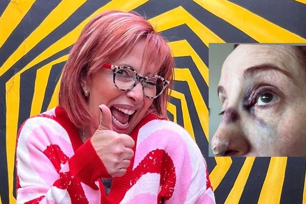 La presentadora Yaneth Waldman apareció con su cara llena morados y la nariz vendada.