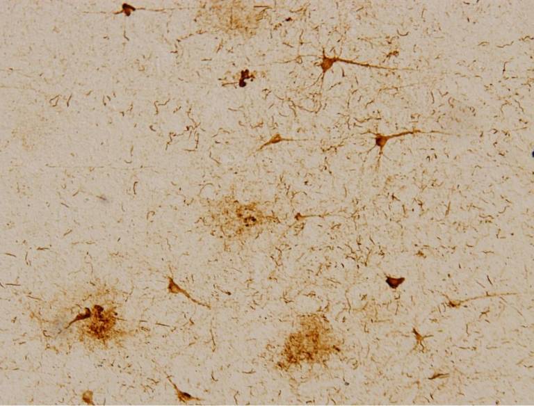 Un gigantesco mapa molecular revela pistas clave sobre el alzhéimer y el párkinson