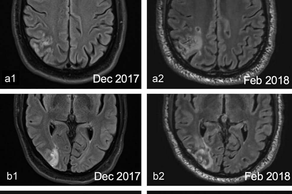 Imágenes de la resonancia practicada por los médicos al paciente holandés.  / Tomada de Journal Neurocase