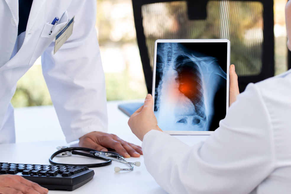 Cáncer de pulmón