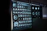 Inteligencia artificial podría diagnosticar el cáncer con el doble de precisión