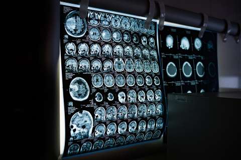 Inteligencia artificial podría diagnosticar el cáncer con el doble de precisión