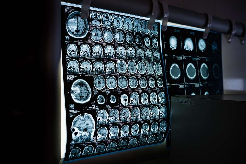 En el 80 % de los casos la inteligencia artificial tuvo el doble de precisión que las biopsias.