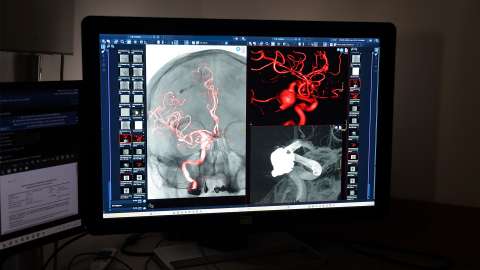 Aneurisma cerebral: factores de riesgo, detección y tratamiento