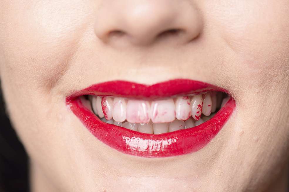 Labial en los dientes